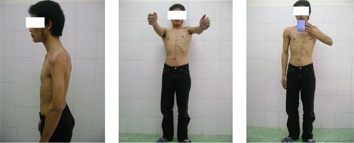Điều trị di chứng liệt dây thần kinh ở chi trên bằng phẫu thuật chuyển gân - Bệnh viện 108