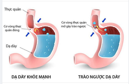 CHUYÊN GIA BẬT MÍ DẤU HIỆU NHẬN BIẾT SỚM TRÀO NGƯỢC DẠ DÀY THỰC QUẢN