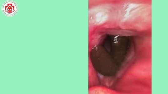 Hy hữu một sinh vật nghi con đỉa nằm lâu ngày ở khí quản bệnh nhân - Bệnh viện 108