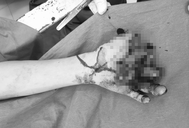 Bé trai 14 tuổi bị cụt 3 ngón tay vì pin quạt tích điện phát nổ - Bệnh viện Việt Đức