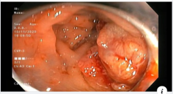 ĐẠI TIỆN RA MÁU TRIỆU CHỨNG NGUY HIỂM CỦA UNG THƯ TRỰC TRÀNG