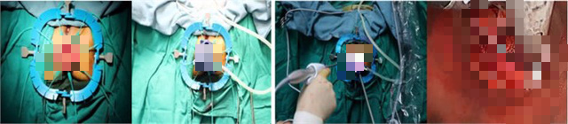 Bệnh viện TƯQĐ 108 đã tiến hành thường quy phẫu thuật nội soi cắt toàn bộ mạc treo trực tràng qua đường hậu môn - Bệnh viện 108