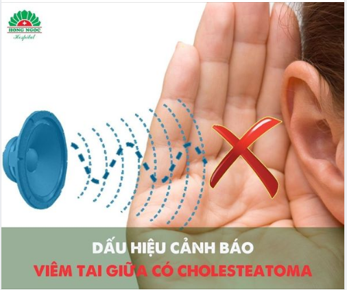 Dấu hiệu cảnh báo mắc VIÊM TAI GIỮA CÓ CHOLESTEATOMA