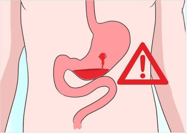 ĐỪNG PHỚT LỜ NHỮNG DẤU HIỆU CẢNH BÁO XUẤT HUYẾT DẠ DÀY DƯỚI ĐÂY