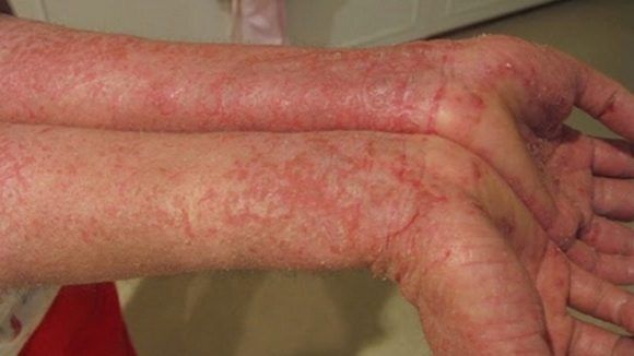 Các dạng viêm da dị ứng -bệnh viện nhi Trung Ương