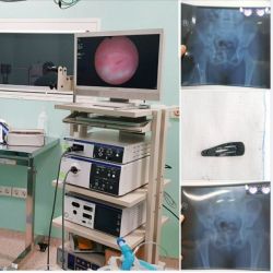 DÙNG ỐNG NỘI SOI MỀM KỊP THỜI GẮP  CHIẾC KẸP TÓC "MẮC KẸT TRONG CÁI NGÀN VÀNG" CỦA BÉ GÁI SUỐT BA THÁNG TIỂU ĐAU ĐIỀU TRỊ BÊN NGOÀI KHÔNG DỨT