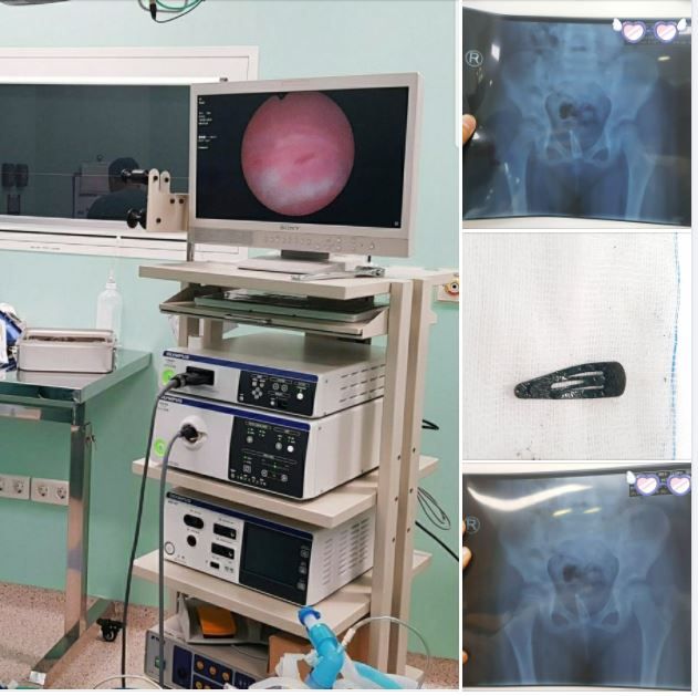 DÙNG ỐNG NỘI SOI MỀM KỊP THỜI GẮP  CHIẾC KẸP TÓC "MẮC KẸT TRONG CÁI NGÀN VÀNG" CỦA BÉ GÁI SUỐT BA THÁNG TIỂU ĐAU ĐIỀU TRỊ BÊN NGOÀI KHÔNG DỨT