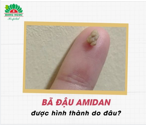 "GIẢI MÃ" NGUYÊN NHÂN HÌNH THÀNH BÃ ĐẬU AMIDAN BÃ ĐẬU AMIDAN là các khối hạt nhỏ màu vàng hoặc trắng bột như bã đậu.