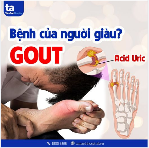 GOUT (GÚT) LÀ BỆNH CỦA NGƯỜI GIÀU?