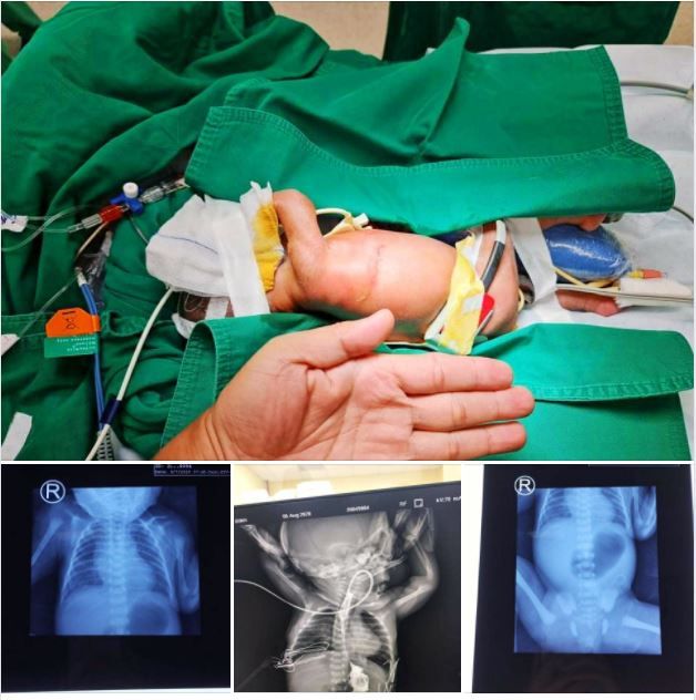 HAI LẦN MỔ SỬA CHỮA NGOẠN MỤC ĐA DỊ TẬT ĐƯỜNG TIÊU HOÁ: "TEO TRÊN TẮC DƯỚI", "ĐƯỜNG ĂN DÍNH ĐƯỜNG THỞ" CHO BÉ GÁI NON THÁNG