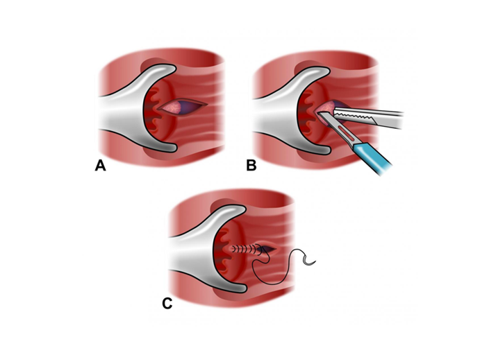 Bệnh nứt kẽ hậu môn -Bệnh Viện Việt Đức