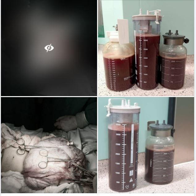 Hơn 300 phút để giải quyết khối u buồng trứng gần 12 kg cho bé gái chỉ mới 13 tuổi