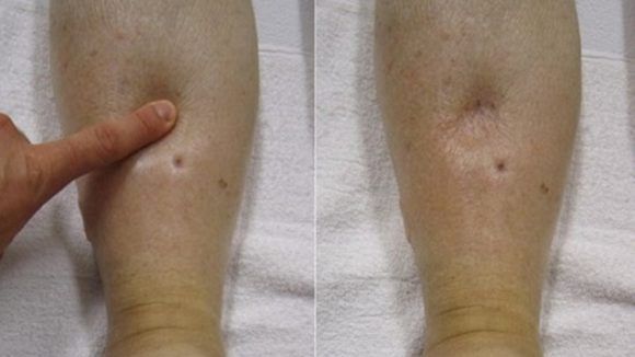 Những điều cần biết về Hội chứng thận hư ở trẻ em - Bệnh viện nhi Trung Ương