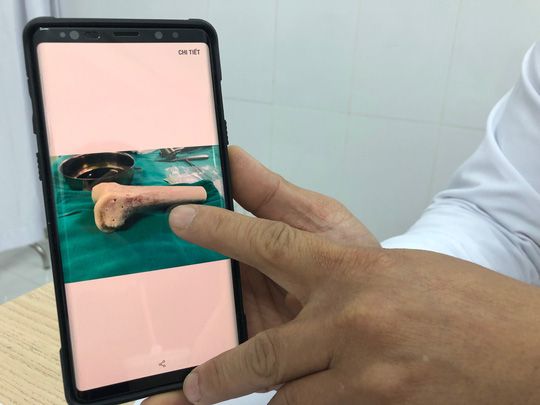 Ghép xương từ người hiến chết não cứu chân bệnh nhân bị u tế bào khổng lồ - Bệnh viện Việt Đức