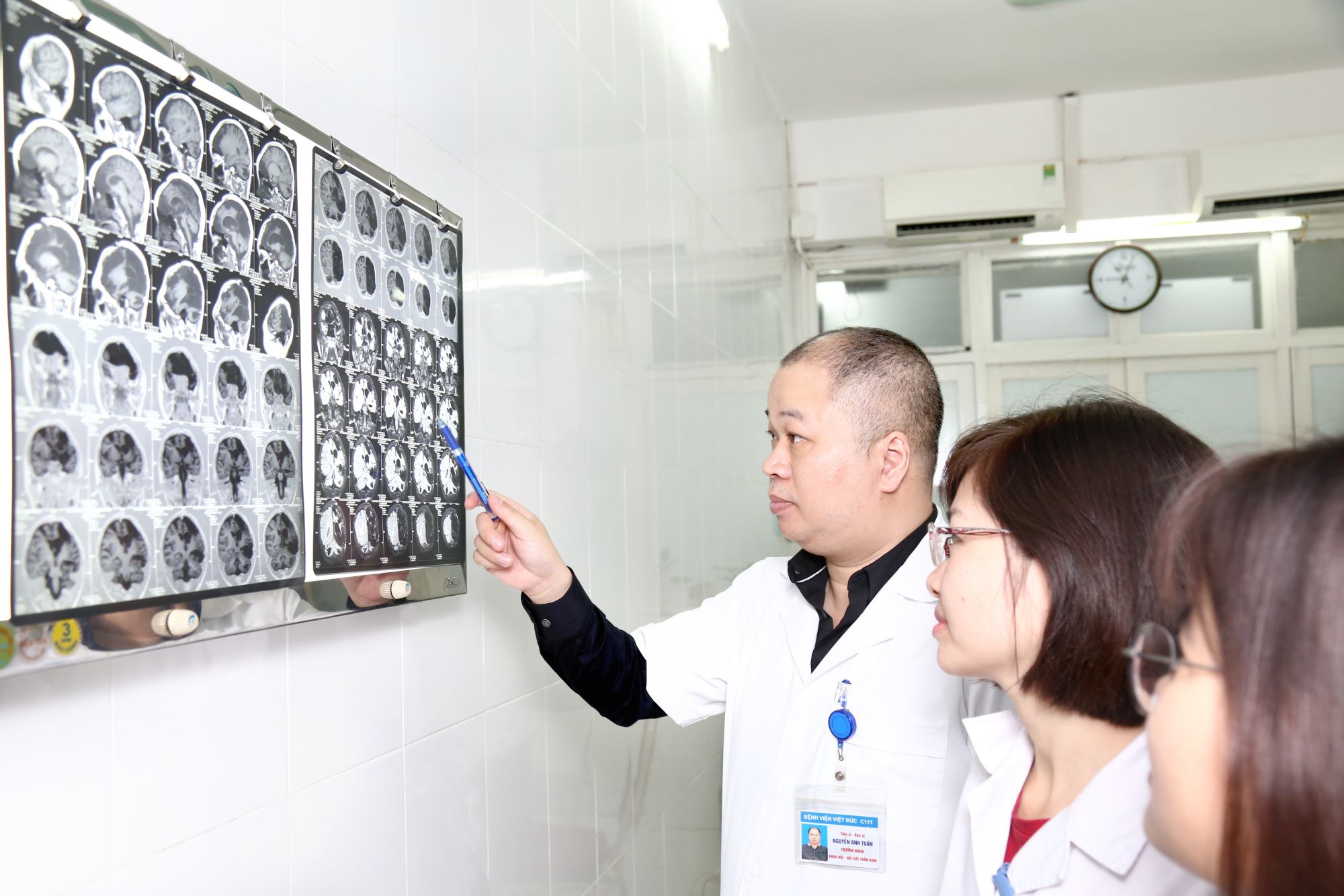 25% ca đột quỵ não xảy ra ở những người trẻ tuổi - Bệnh viện Việt Đức