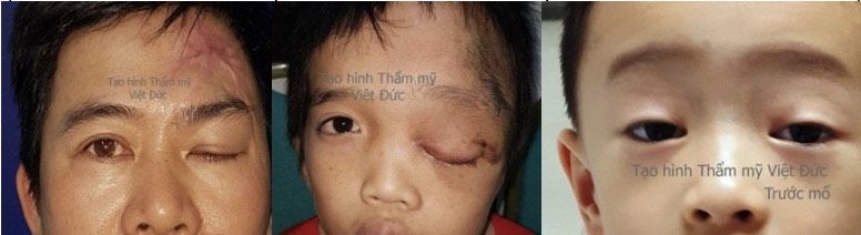 Bệnh lý sụp mi và những điều cần biết- Bệnh viện Việt Đức