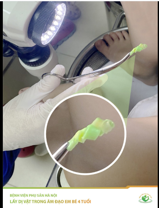 Lấy dị vật trong âm đạo bé 4 tuổi Ba mẹ hãy quan tâm đến giáo dục giới tính cho con từ nhỏ