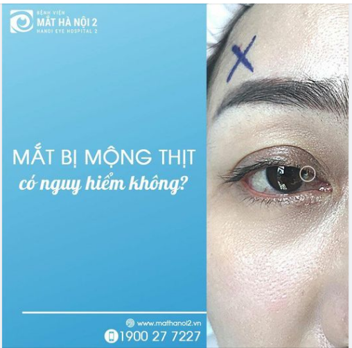 Mắt bị mộng thịt có nguy hiểm không