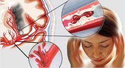 Nguy cơ đột quỵ ở người mỡ máu cao khi giao mùa