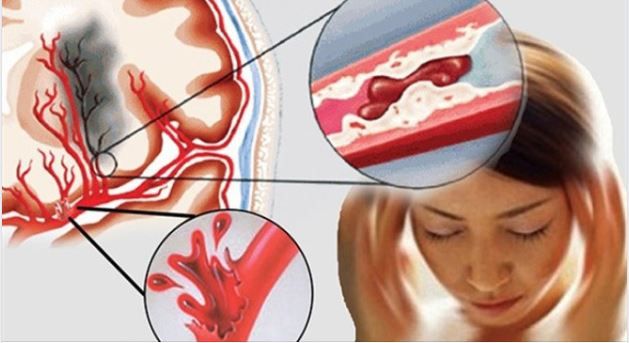 Nguy cơ đột quỵ ở người mỡ máu cao khi giao mùa