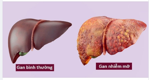 Nhận biết DẤU HIỆU gan nhiễm mỡ qua 3 cấp độ