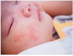 NHẬN BIẾT VÀ XỬ TRÍ KHI TRẺ BỊ DỊ ỨNG ĐẠM BÒ