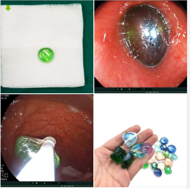 NỘI SOI GẮP KỊP THỜI VIÊN SỎI THỦY TINH HỒ CÁ CHẶN NGANG ĐẦU THỰC QUẢN BÉ TRAI 3 TUỔI