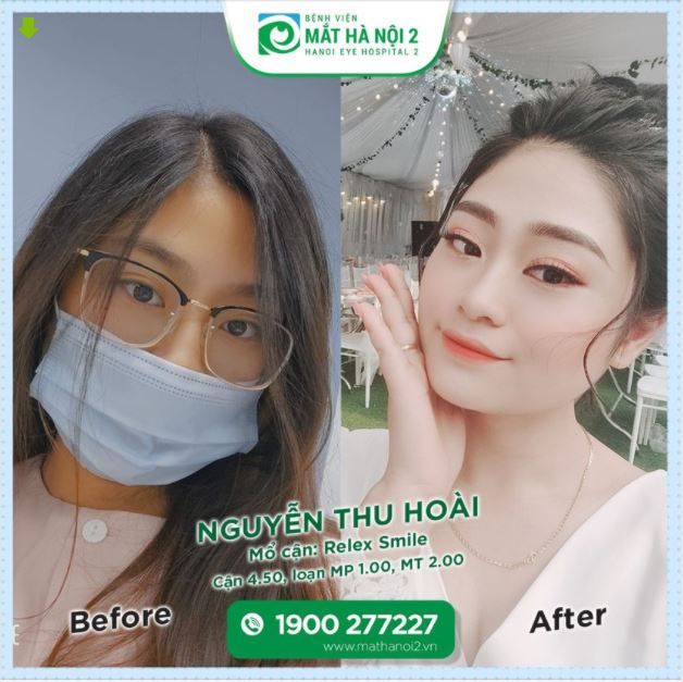 NỮ DƯỢC SĨ MỔ CẬN RELEX SMILE HÓA CÔ DÂU XINH XUẤT SẮC