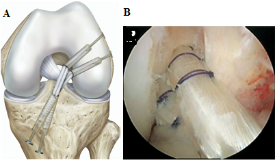Các phương pháp phẫu thuật tái tạo dây chằng chéo trước khớp gối-Bệnh Viện Việt Đức