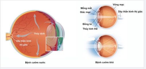 Phân biệt cườm mắt: Cườm khô với Cườm nước