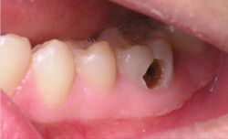 PHÁT HIỆN SỚM TRIỆU CHỨNG, ĐIỀU TRỊ HIỆU QUẢ SÂU RĂNG Ở TRẺ