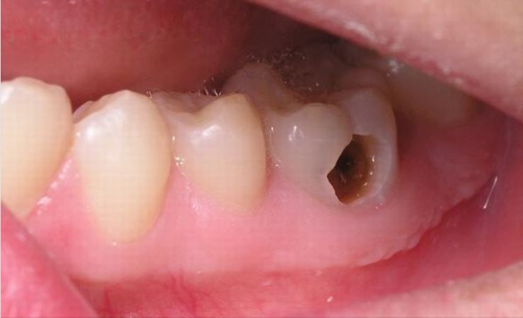 PHÁT HIỆN SỚM TRIỆU CHỨNG, ĐIỀU TRỊ HIỆU QUẢ SÂU RĂNG Ở TRẺ