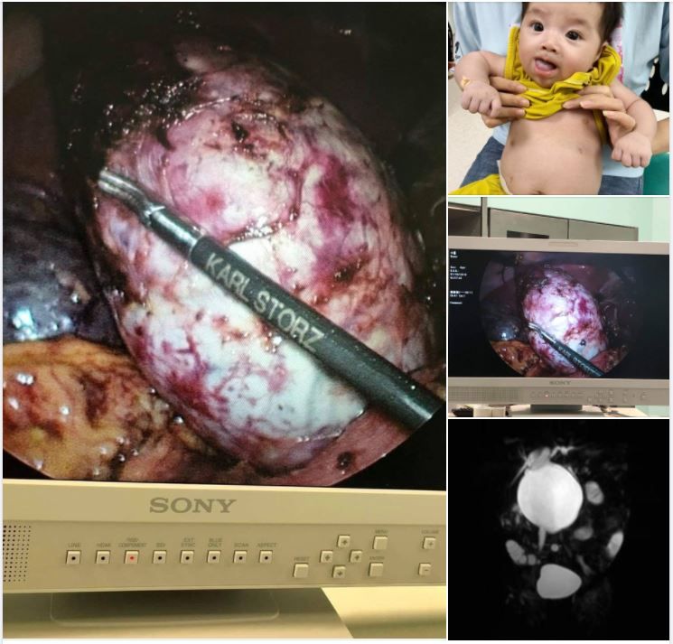 PHẪU THUẬT NỘI SOI: ĐƯA ĐÈN VÀ DAO MỔ VÀO BỤNG BẰNG 3 LỖ TÍ HON ĐIỀU TRỊ THÀNH CÔNG LIÊN TIẾP NANG ỐNG MẬT CHỦ 'TO BẰNG NẮM TAY" CHO TRẺ CHƯA ĐẦY 2 THÁNG TUỔI
