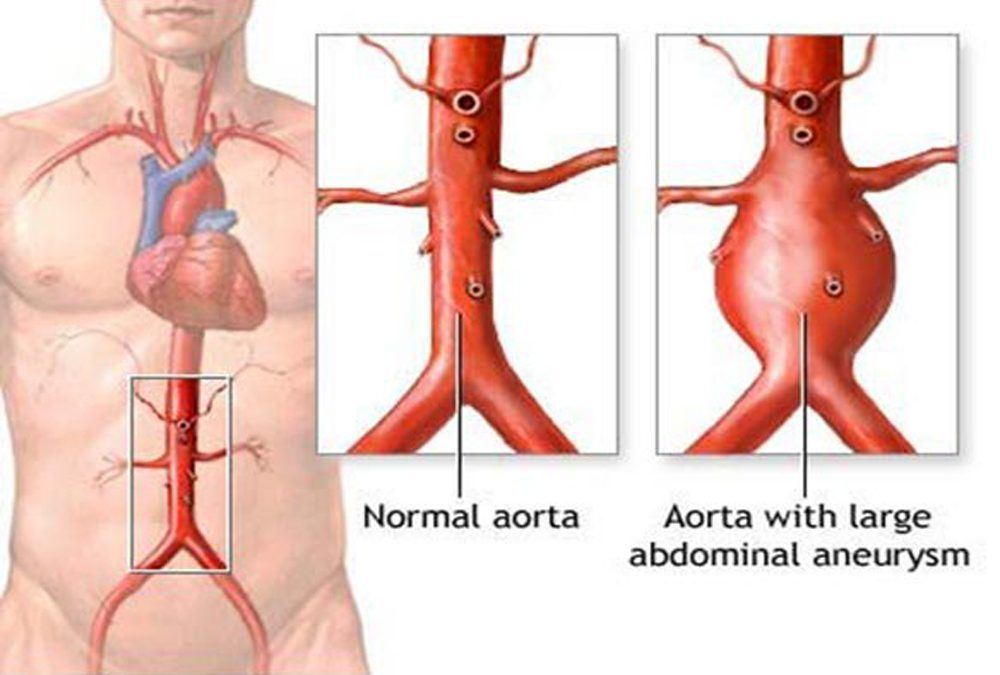 Kiểm soát tốt các yếu tố nguy cơ để phòng bệnh phình động mạch chủ bụng- Bệnh viện Việt Đức