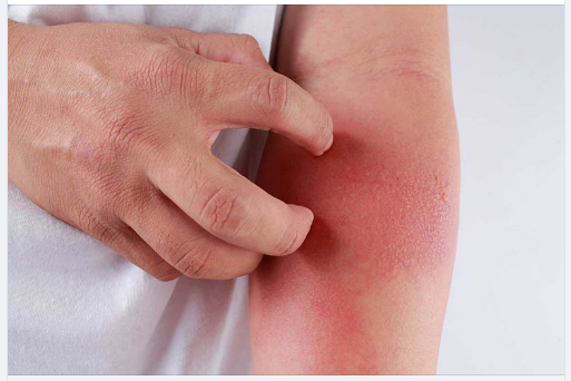 PHÒNG NGỪA DỊ ỨNG THỜI TIẾT KHI TRỜI CHUYỂN LẠNH