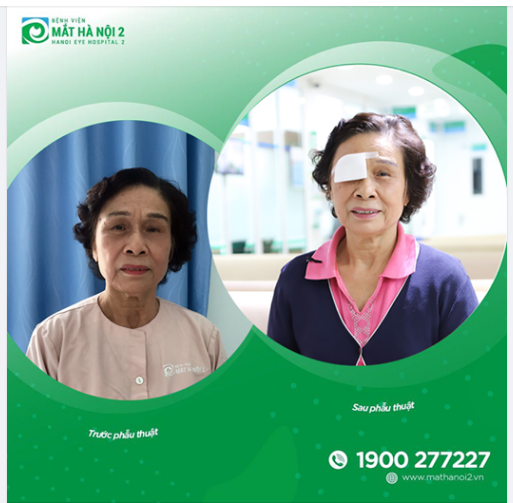 Quá trình "mổ mắt" Phaco xuất viện TRONG NGÀY