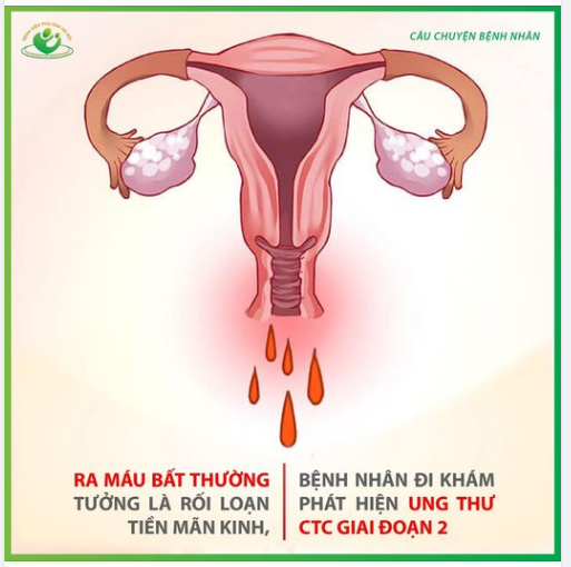 Ra máu bất thường chủ quan không đi khám người phụ nứ được chẩn đoán ung thư cổ tử cung giai đoạn 2