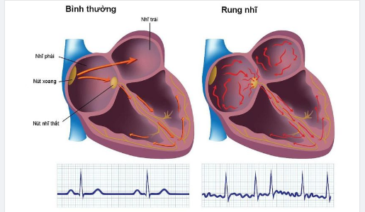 RUNG NHĨ: RỐI LOẠN NHỊP TIM GÂY NGUY CƠ ĐỘT QUỴ CAO GẤP 5 LẦN