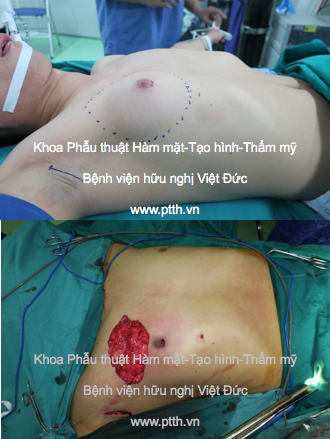 Lần đầu tiên ứng dụng kỹ thuật nội soi qua đường nách cắt bỏ toàn bộ tuyến vú trên bệnh nhân bị hội chứng vú to nam giới - Bệnh viện Việt Đức