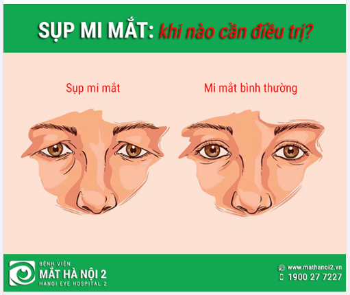 SỤP MI MẮT KHI NÀO CẦN ĐIỀU TRỊ