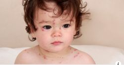 THỦY ĐẬU VÀO MÙA, LÀM SAO ĐỂ PHÒNG TRÁNH BỆNH Ở TRẺ?