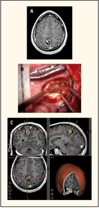 Lựa chọn phẫu thuật trong điều trị bệnh lý động kinh - Bệnh viện Việt Đức
