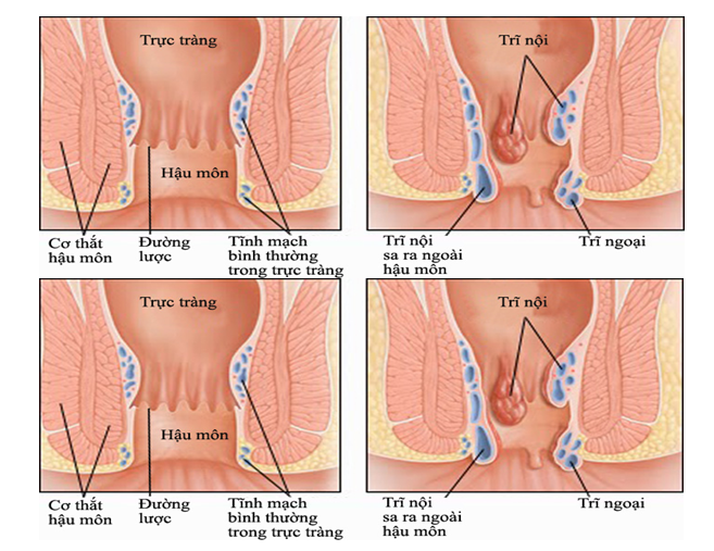 Bệnh trĩ - Bệnh Viện Việt Đức