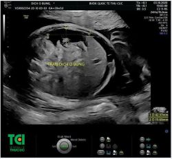 Phát hiện bệnh lý Tràn dịch ổ bụng ở thai nhi qua Siêu âm 5D tại Bệnh viện Thu Cúc