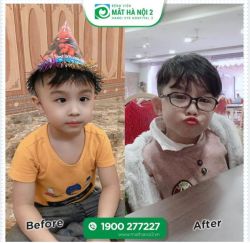 TRẺ MẤY TUỔI THÌ CÓ THỂ PHẪU THUẬT LÁC (LÉ) MẮT