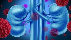 Hiểu biết về bệnh lý Ung thư thận: Phòng bệnh và điều trị - Bệnh viện Việt Đức