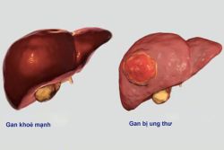 Ung thư “sát thủ” với nam giới bắt nguồn từ bệnh lý mãn tính - Bệnh viện Việt Đức