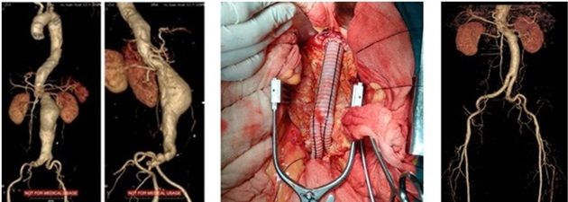 Ứng dụng can thiệp nội mạch điều trị phình động mạch chủ bụng - Bệnh viện 108