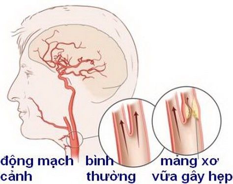 Thiếu máu não do hẹp động mạch cảnh và cách khắc phục - Bệnh viện 108