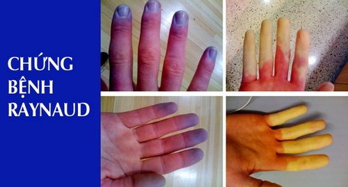 Dấu hiệu và cách xử trí bệnh lý mạch máu ngoại biên - Bệnh viện 108